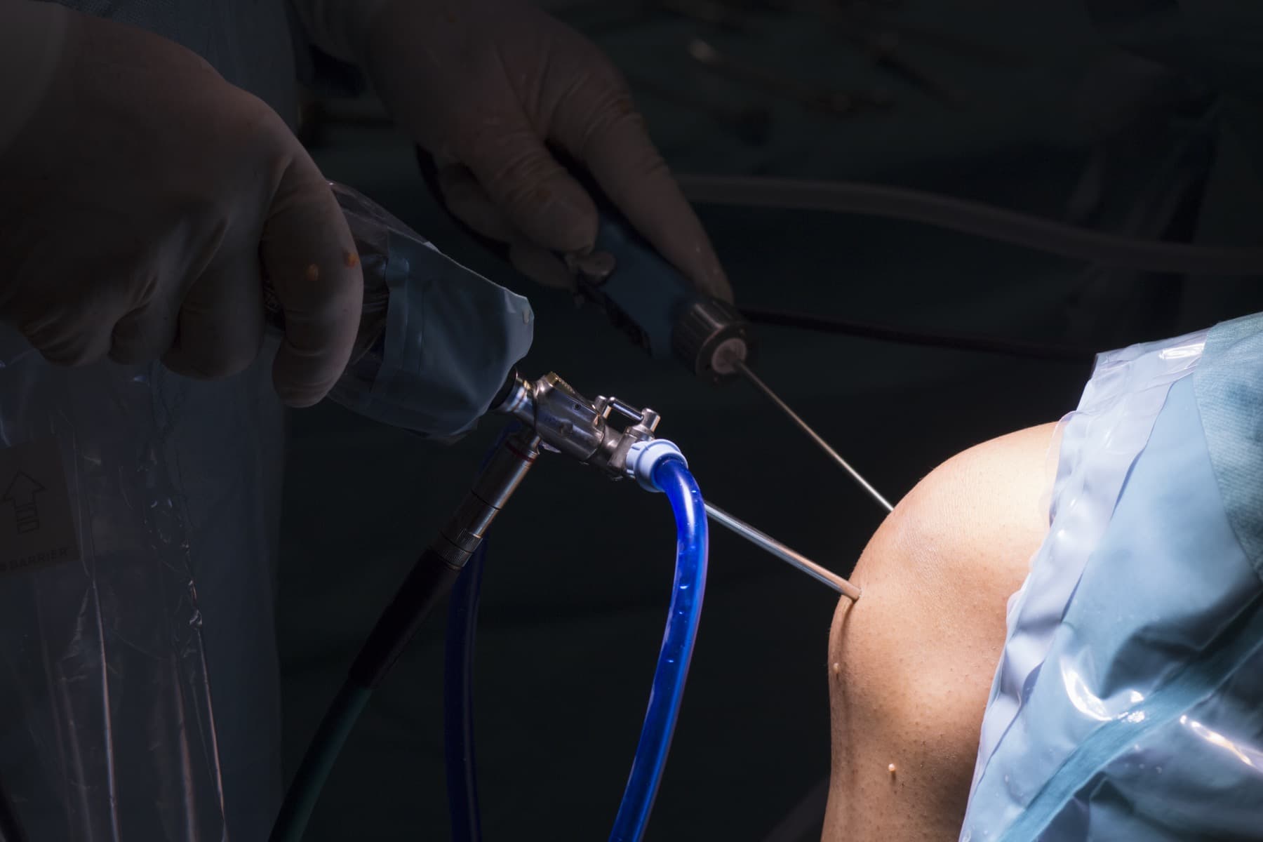 Minimally invasive needle arthroscopy of a joint